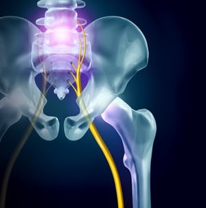 Sciatica | Pain on Sciatic Nerve