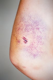 Bruising from a Soft Tissue Injury