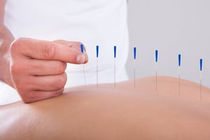 Acupuncture for Headaches