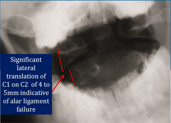 Damage to the Spinal Ligaments