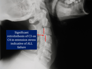 Ligament Damage after an Accident