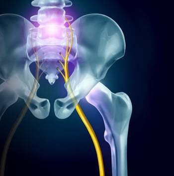 Sciatica Treatment and Relief in Newberry Florida