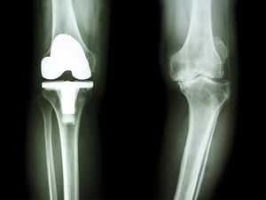 Knee X-Ray for Pain Relief