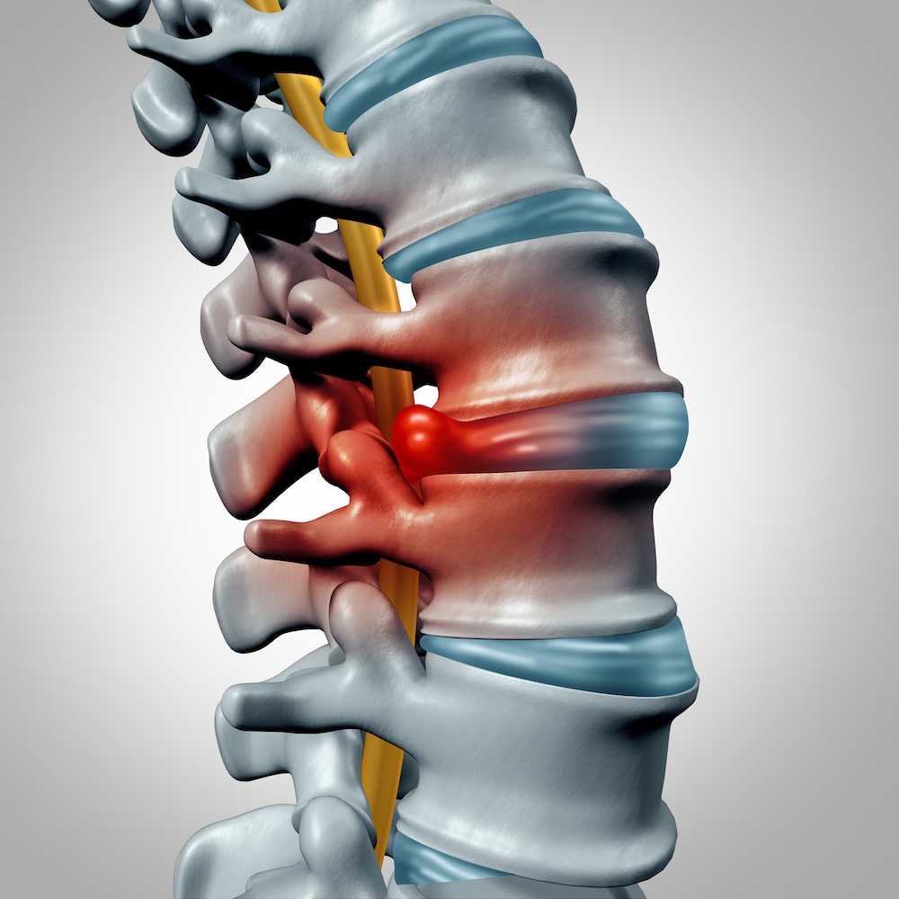 Chiropractic Care for Bulging Discs