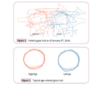 Eye test for brain injury patients
